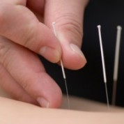 acupuncture-300x200